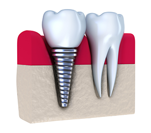 Dental Implants in Vancouver, WA 