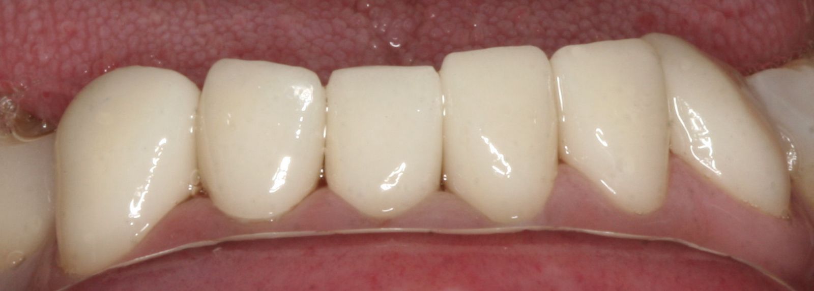  Lower Anterior Teeth After Treatment 