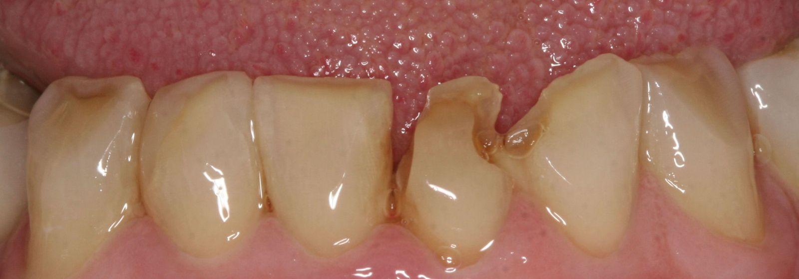 Lower Anterior Teeth Before Treatment 